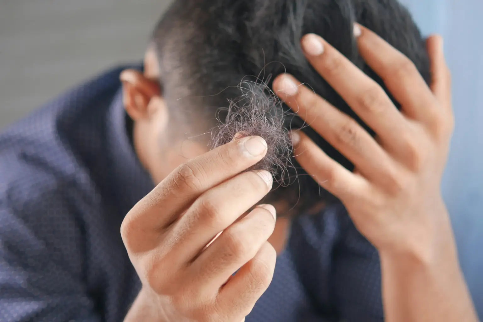 Man suffering from hair loss, can NMN contribute to hair growth?